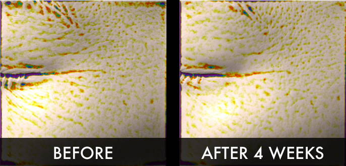 Clinical trial wrinkles before and after 4 weeks
